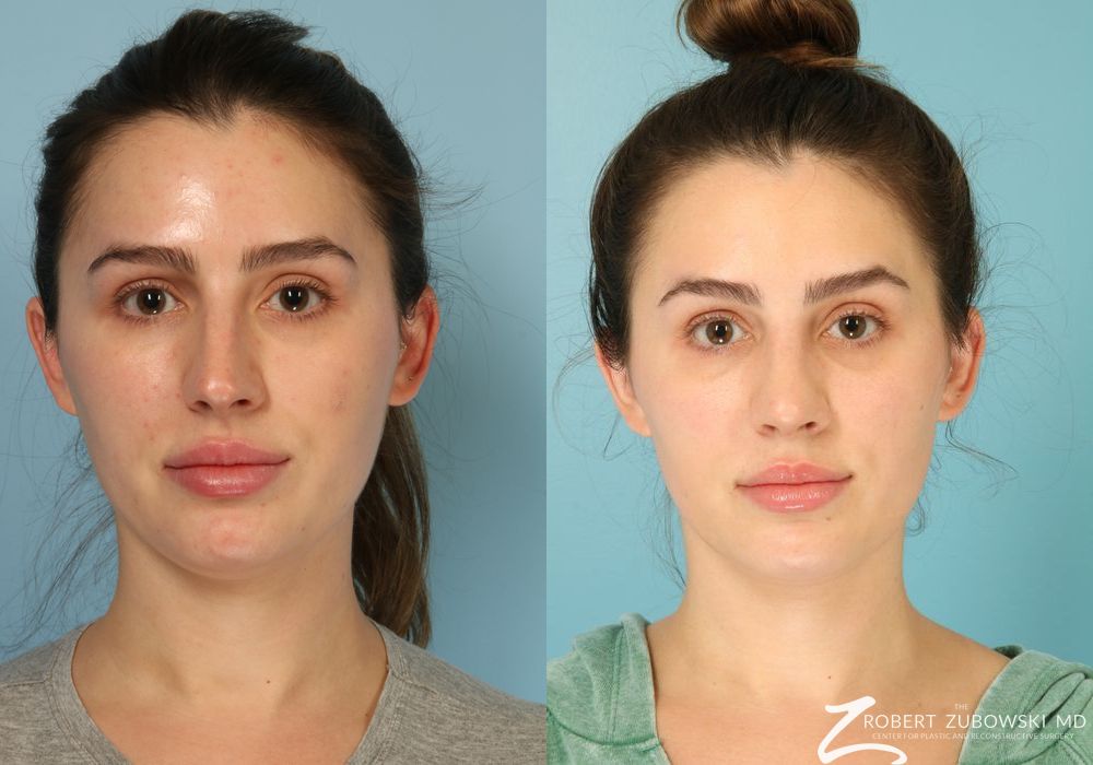 Rhinoplasty - Case 3880