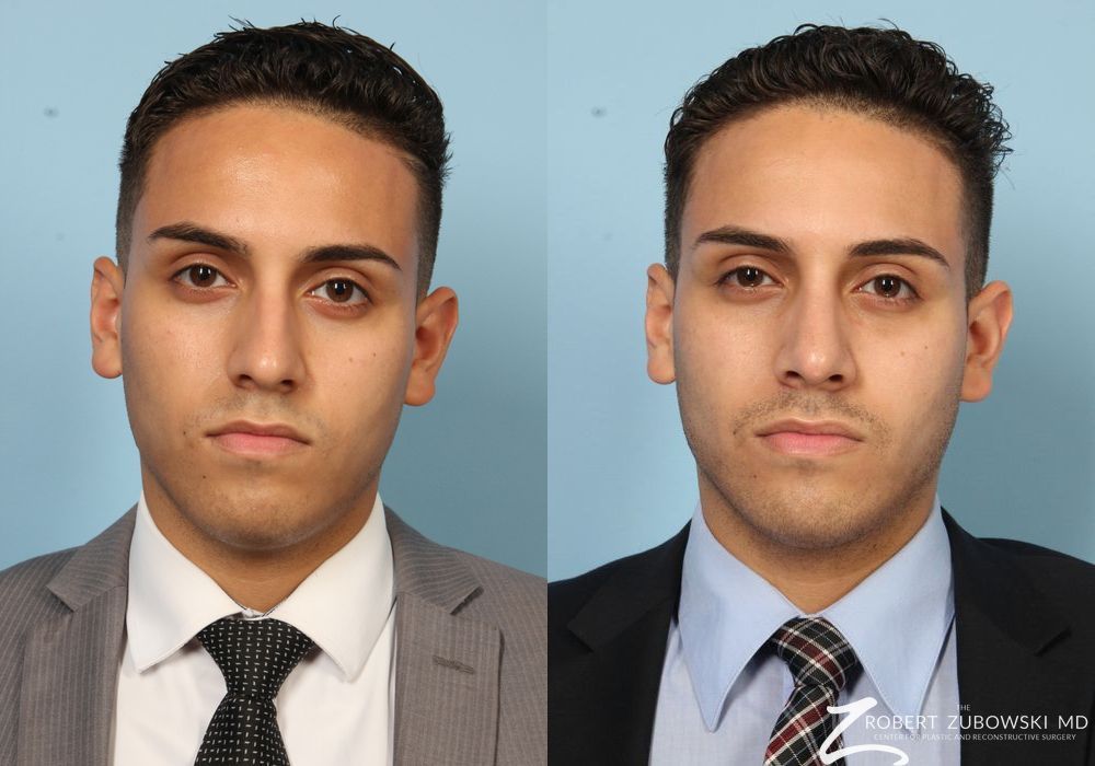 Before and after procedure result