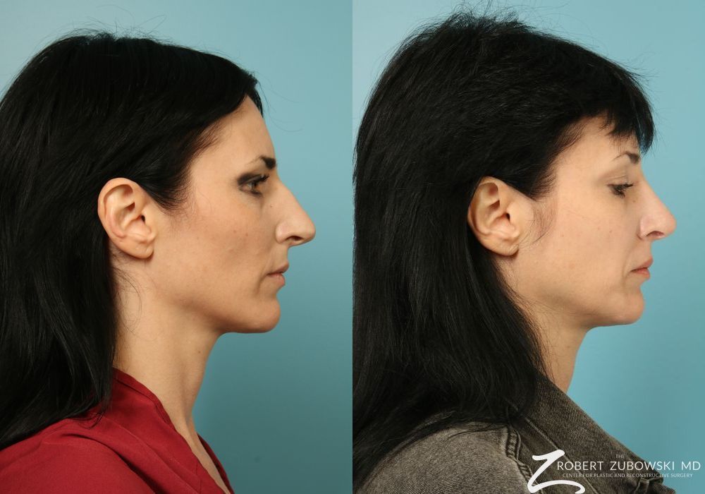 Rhinoplasty - Thumbnail 2