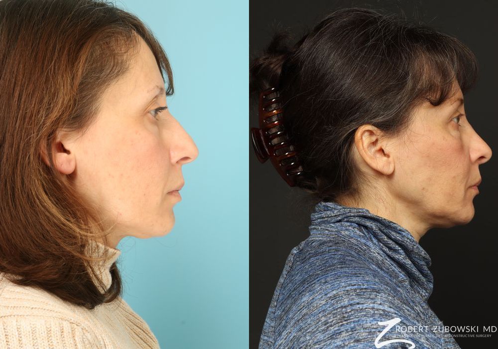 Rhinoplasty - Thumbnail 2