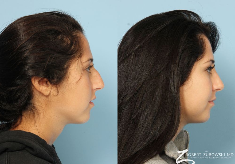 Rhinoplasty - Thumbnail 3