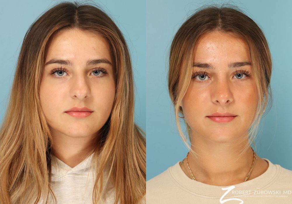 Rhinoplasty - Case 3873