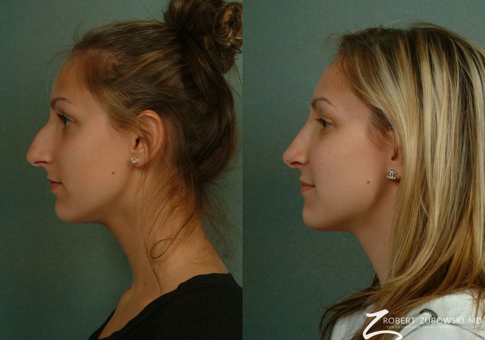 Rhinoplasty - Thumbnail 2
