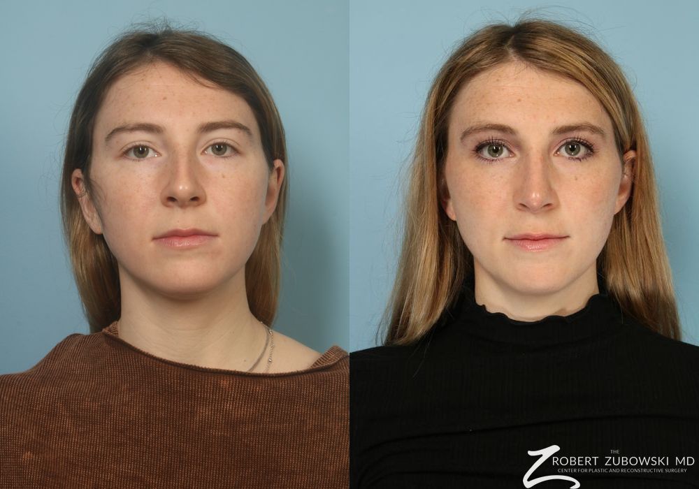 Before and after procedure result