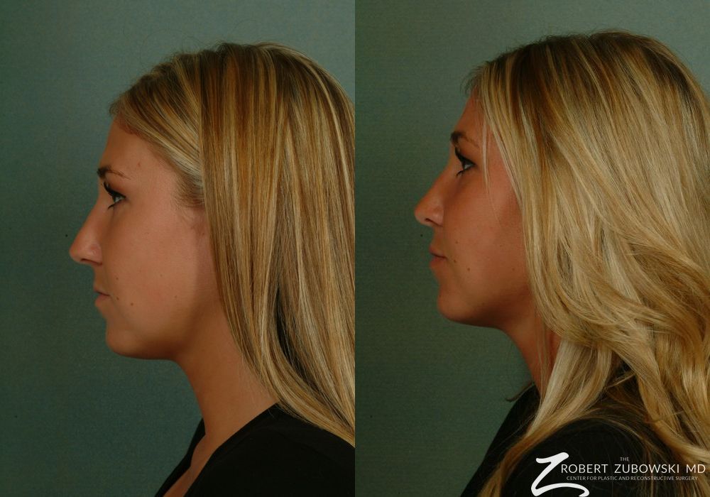 Rhinoplasty - Thumbnail 2