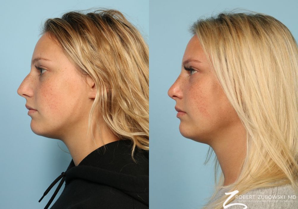 Rhinoplasty - Thumbnail 2