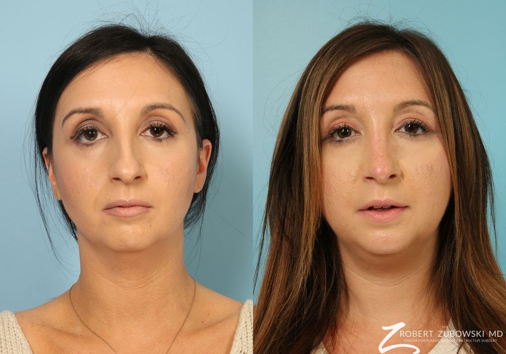 Rhinoplasty - Case 3870