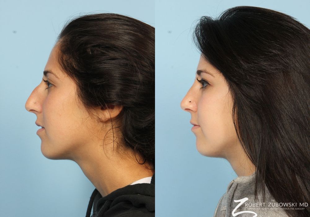 Rhinoplasty - Thumbnail 2