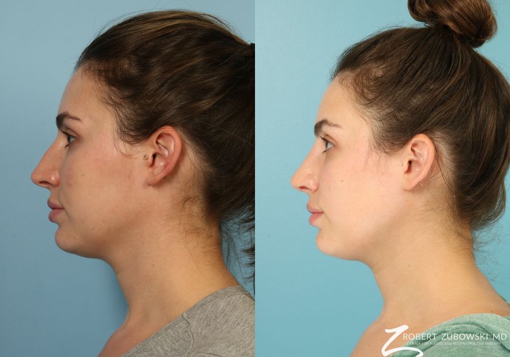 Rhinoplasty - Thumbnail 2