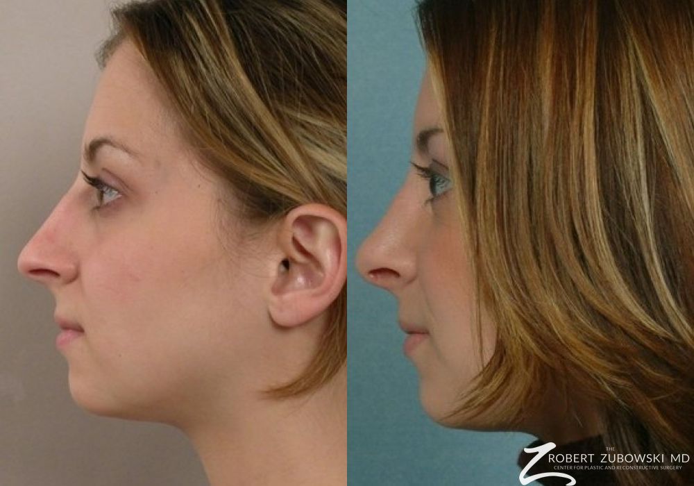 Rhinoplasty - Thumbnail 2