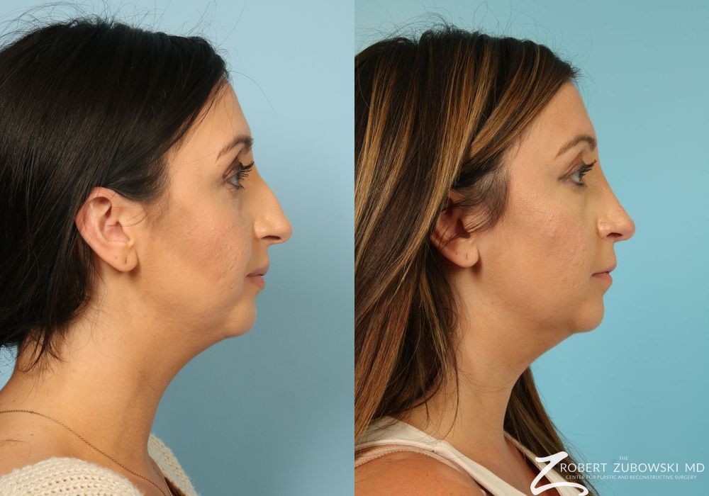 Rhinoplasty - Thumbnail 2