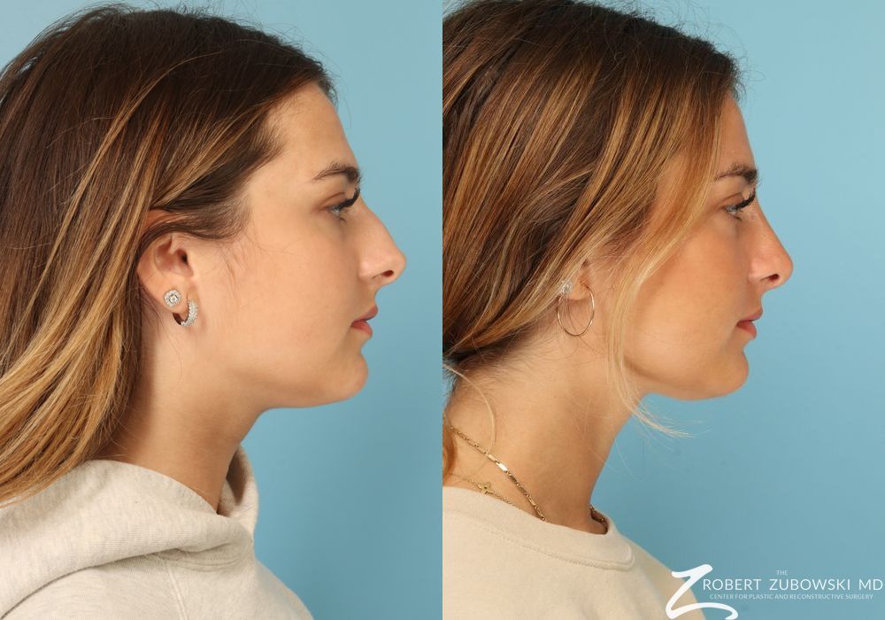 Rhinoplasty - Thumbnail 2