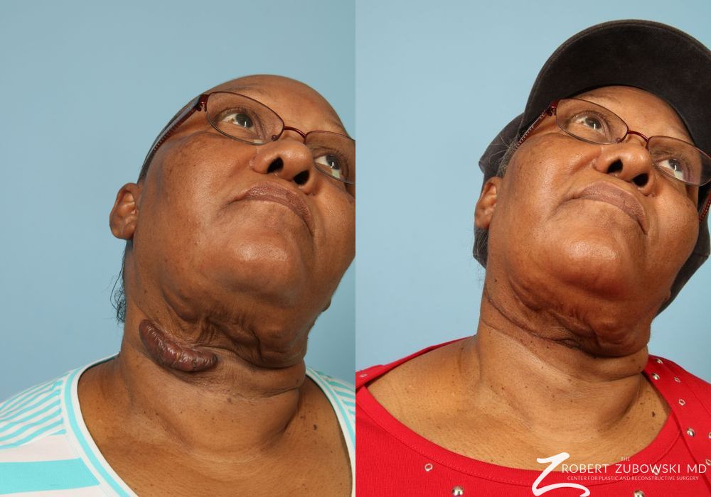 Scar Revision - Thumbnail 2