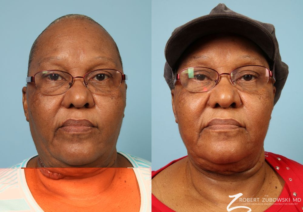 Scar Revision - Case 3927