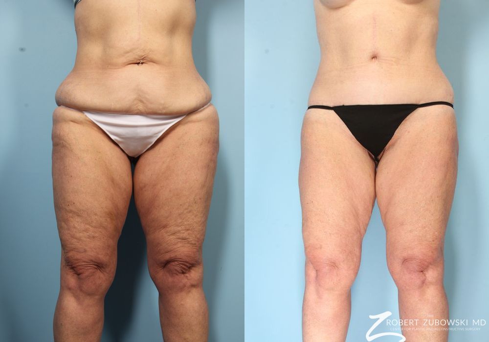 Thigh Lift - Case 3576