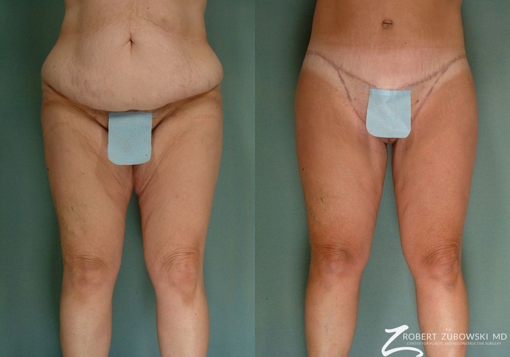 Thigh Lift - Case 3574
