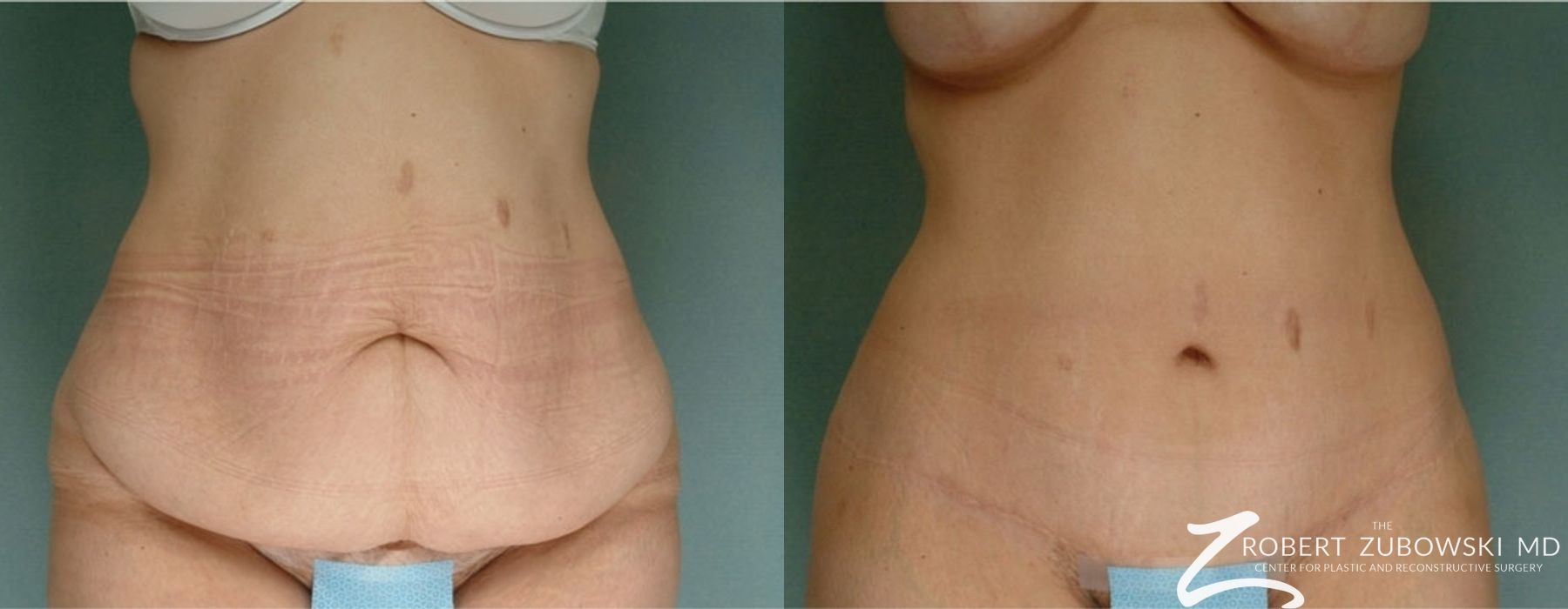 Tummy Tuck - Case 3597