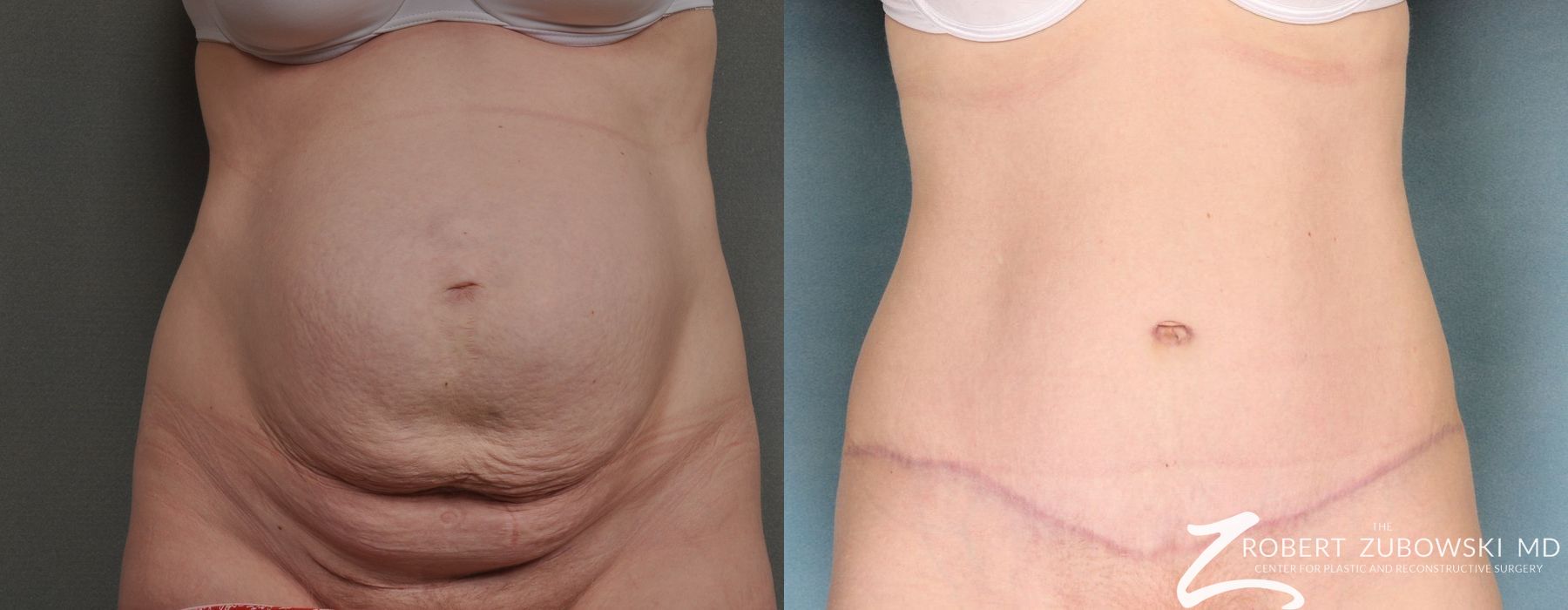 Tummy Tuck - Case 3580