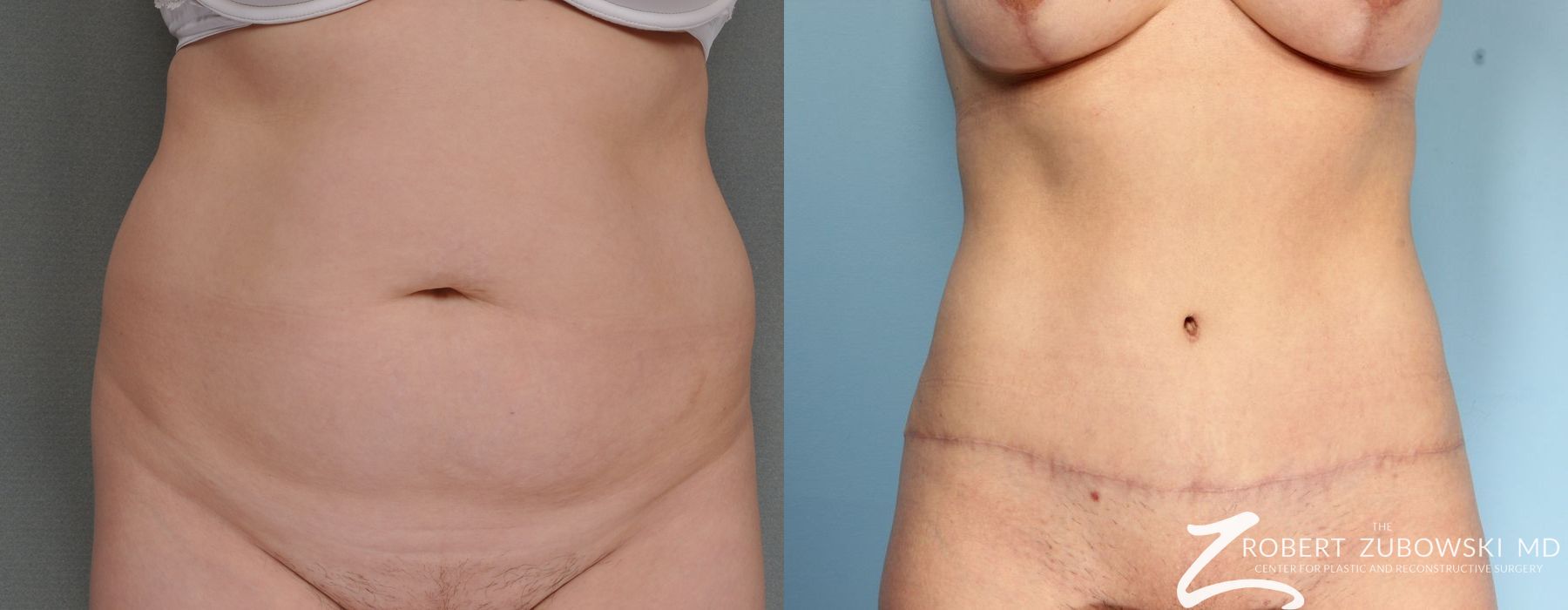 Tummy Tuck - Case 3584