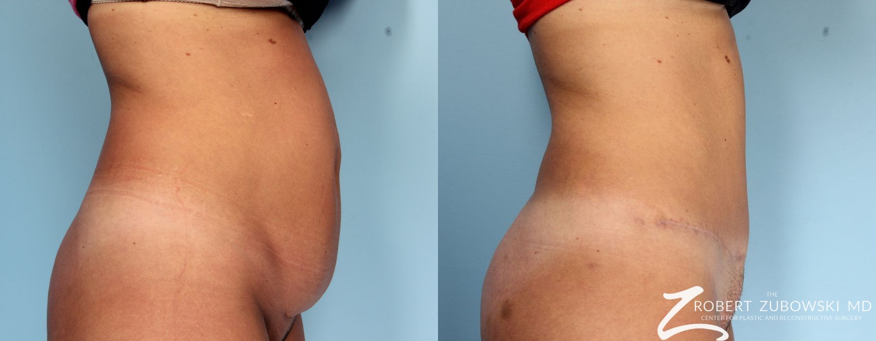 Tummy Tuck - Thumbnail 2