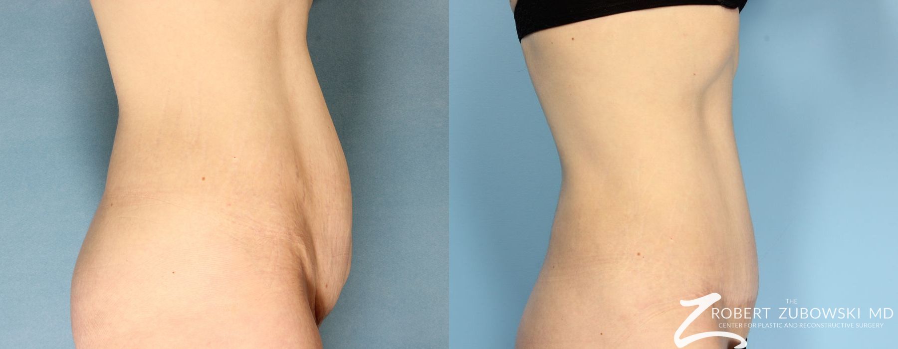 Tummy Tuck - Thumbnail 2