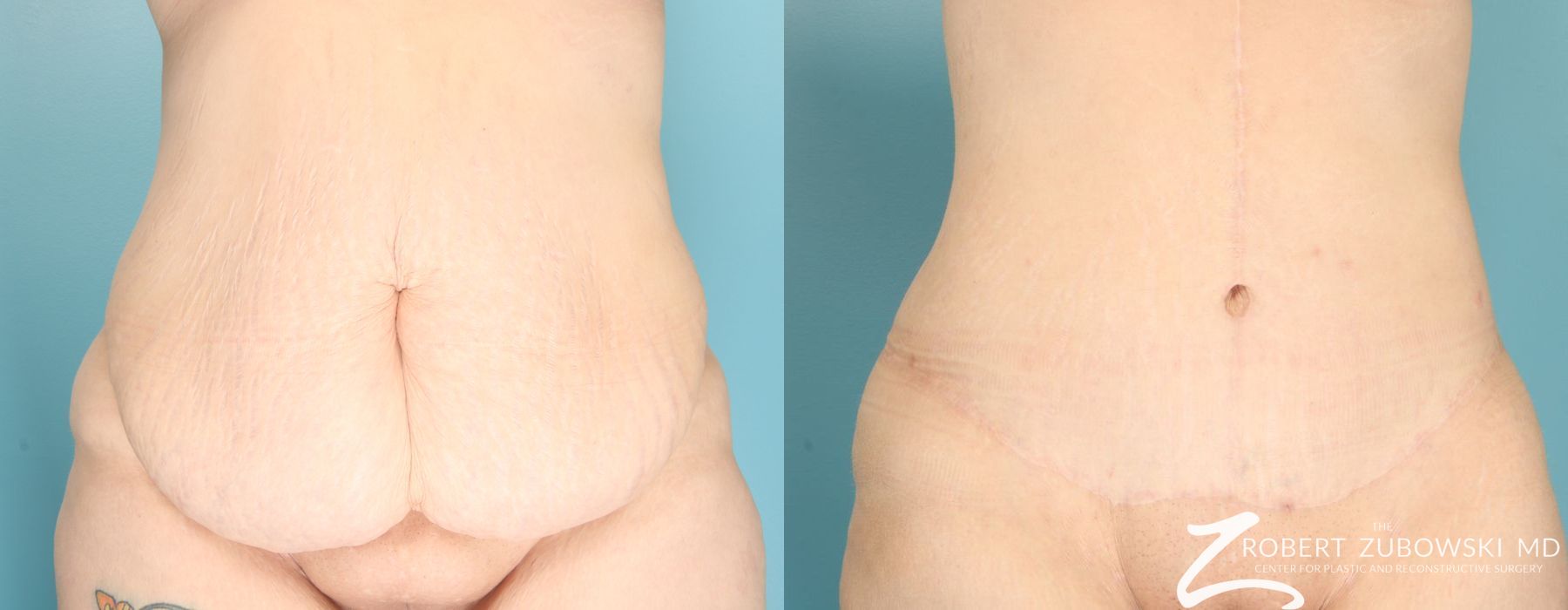 Tummy Tuck - Case 3602