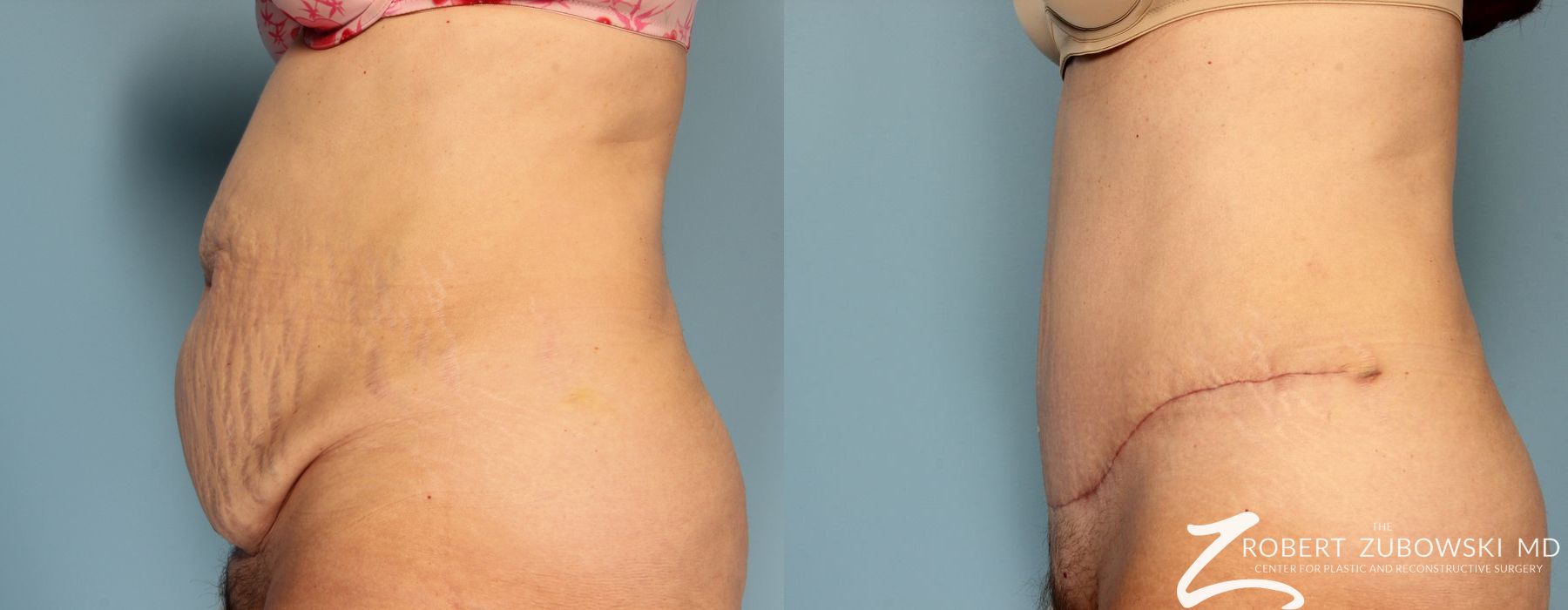 Tummy Tuck - Case 3591