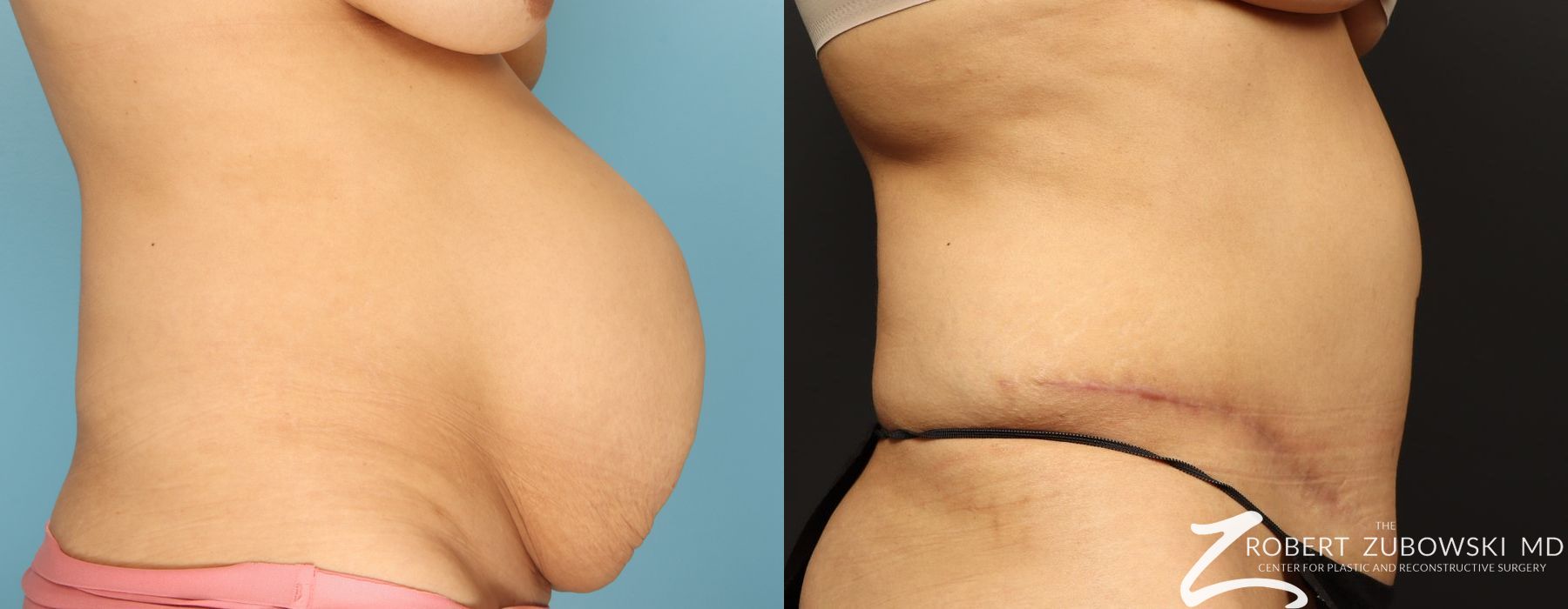 Tummy Tuck - Thumbnail 2