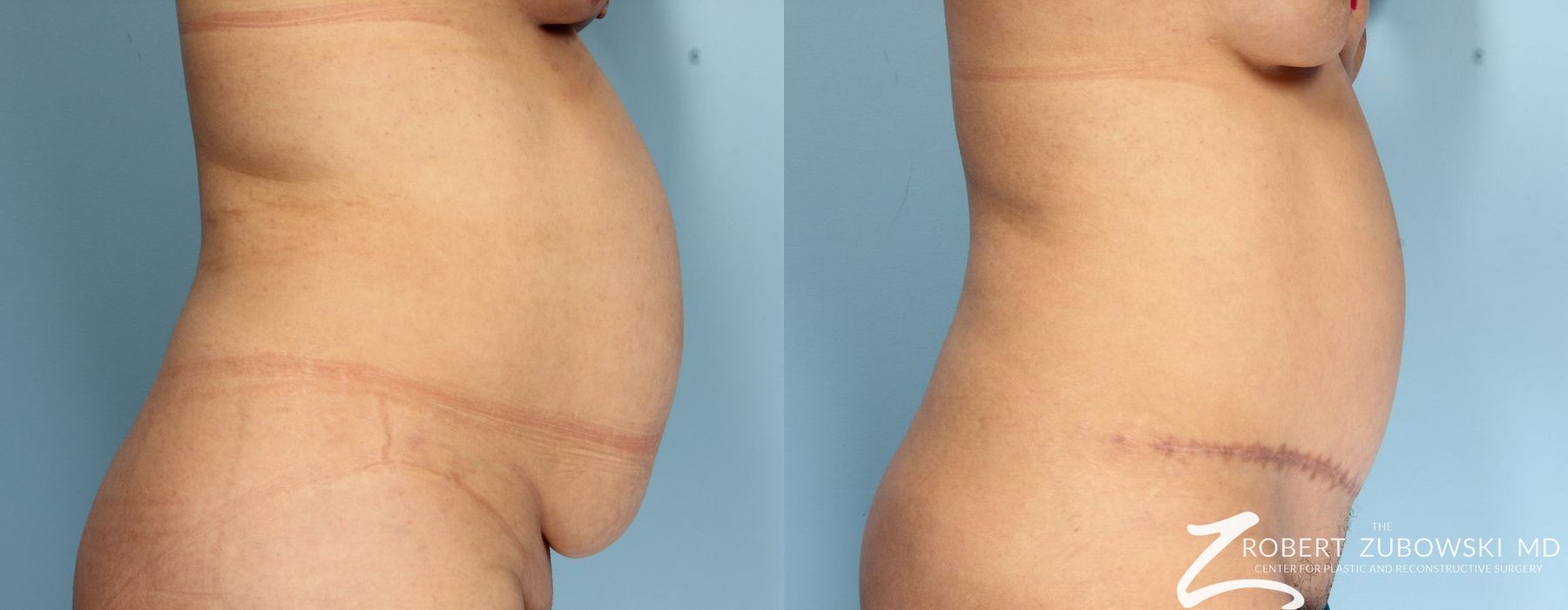 Tummy Tuck - Thumbnail 2