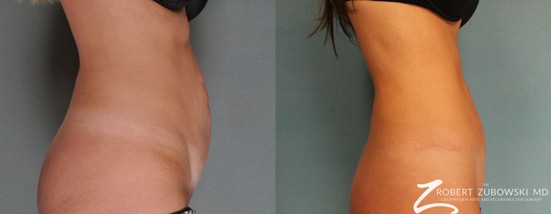 Tummy Tuck - Thumbnail 2