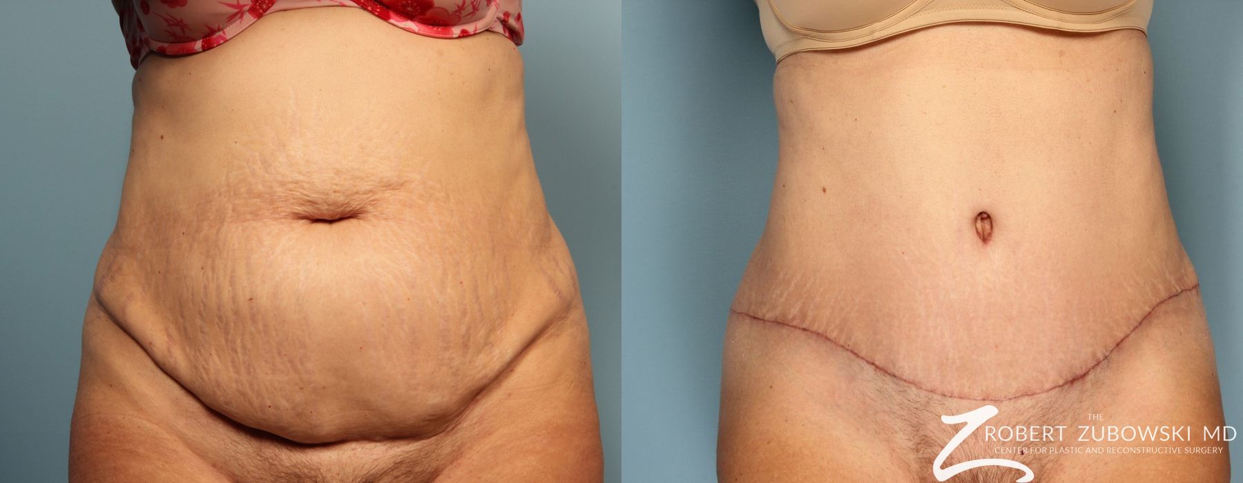 Tummy Tuck - Thumbnail 2