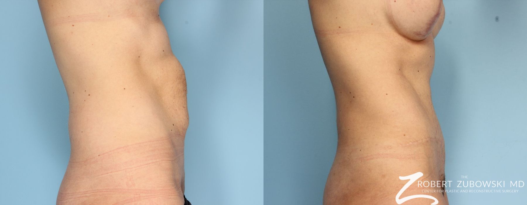 Tummy Tuck - Thumbnail 2