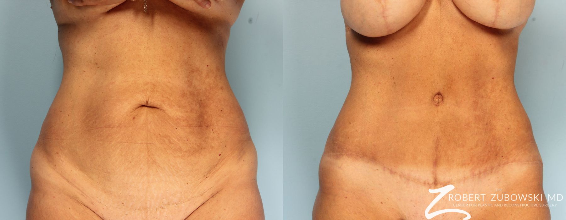 Tummy Tuck - Case 3599