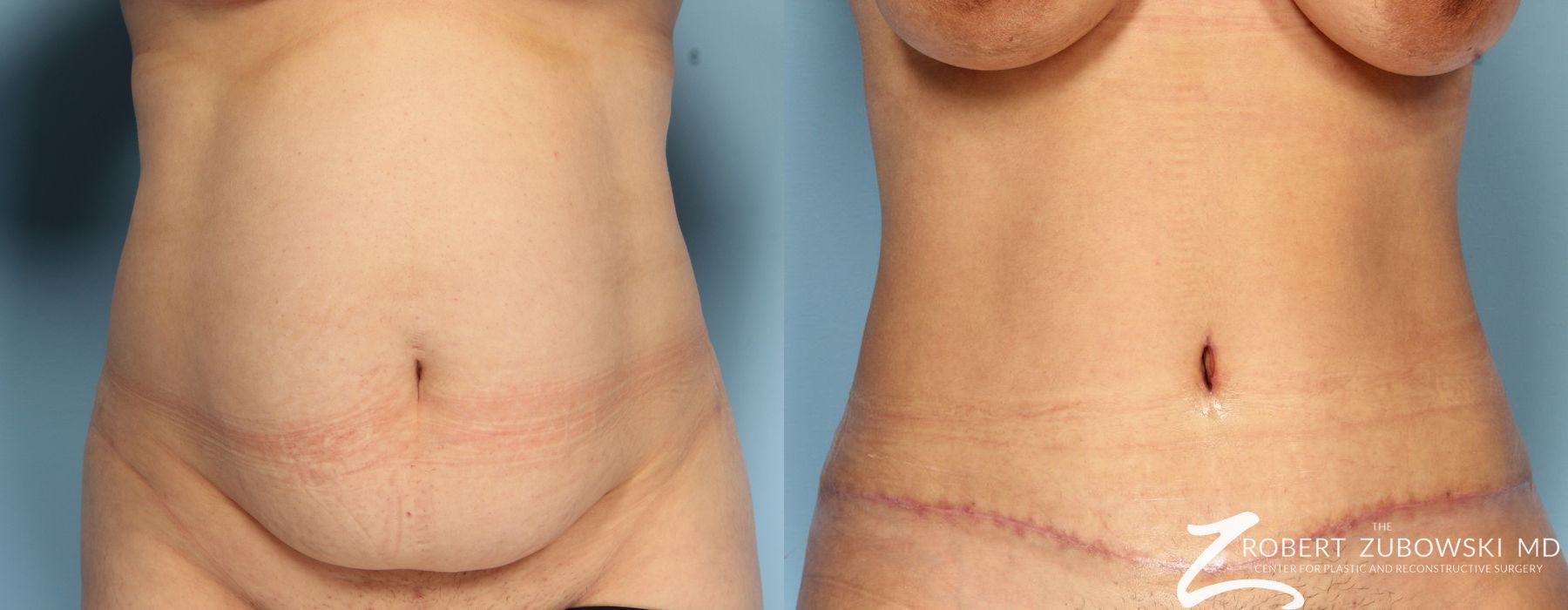 Tummy Tuck - Case 3595