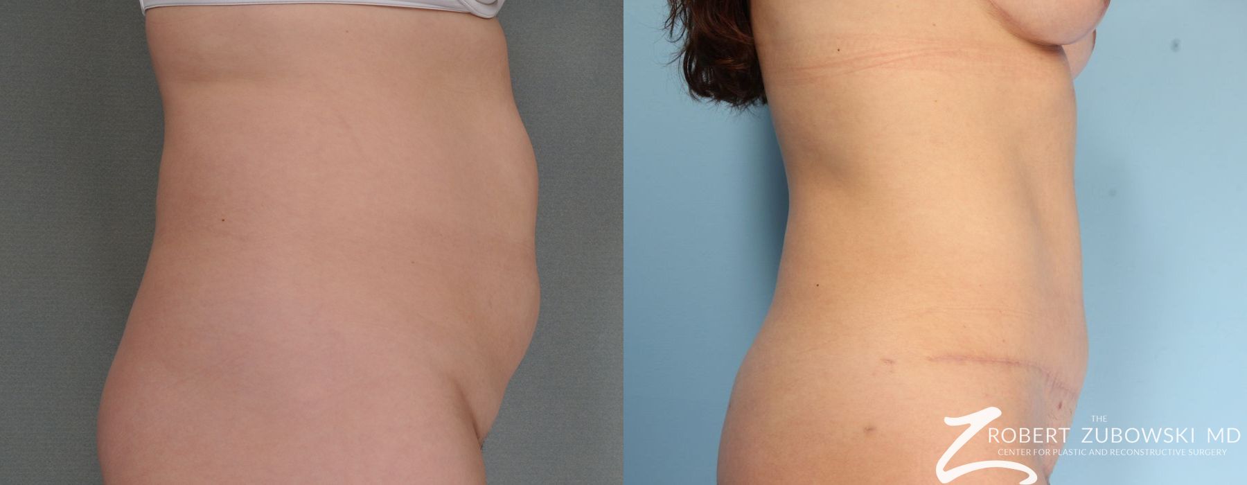 Tummy Tuck - Thumbnail 2