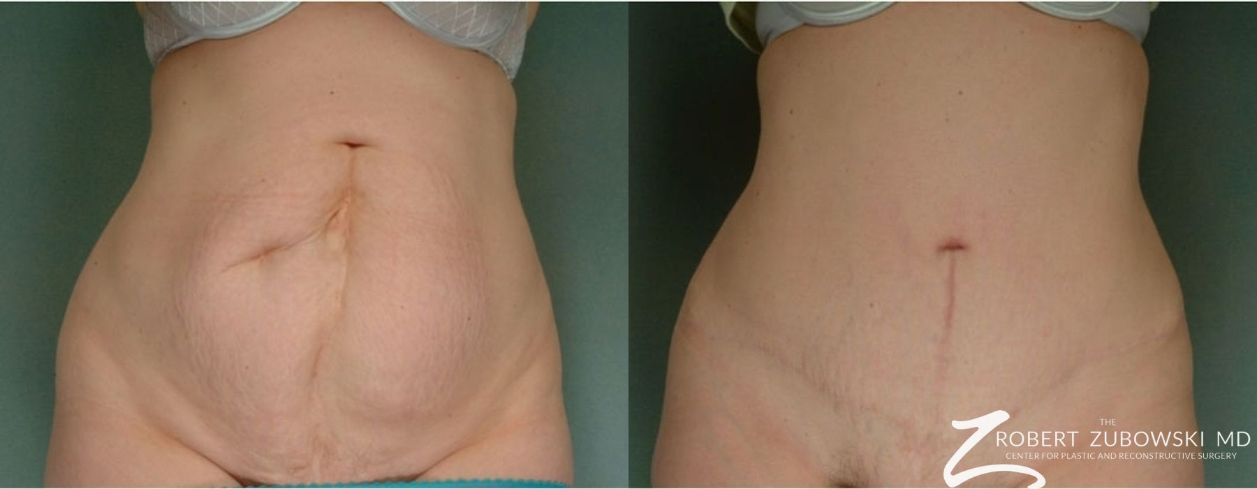 Tummy Tuck - Case 3598