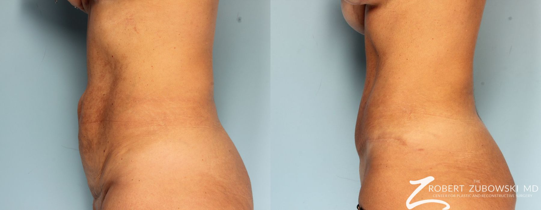 Tummy Tuck - Thumbnail 2