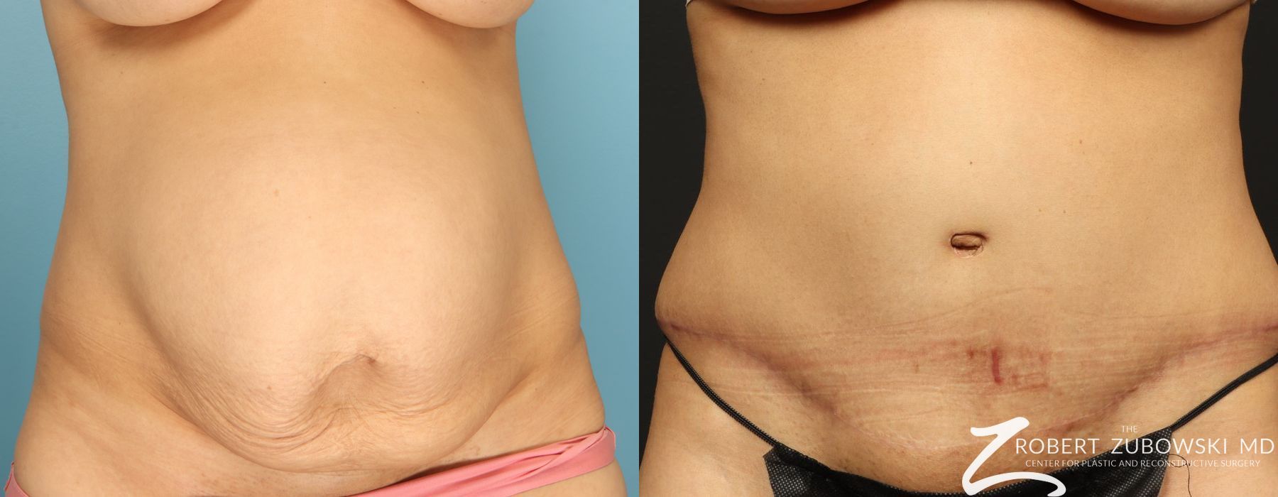 Tummy Tuck - Case 3604