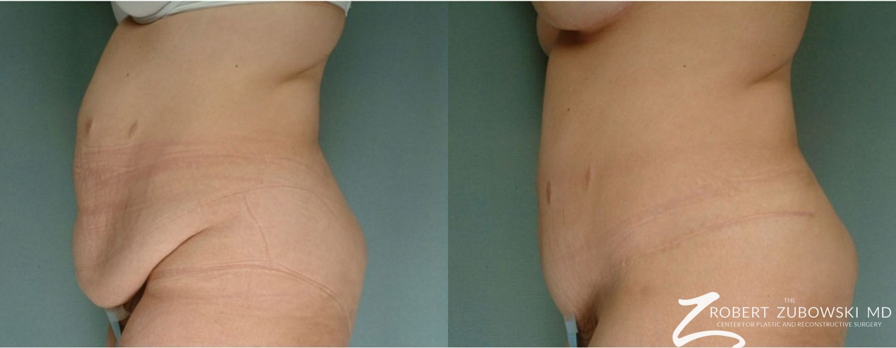 Tummy Tuck - Thumbnail 2