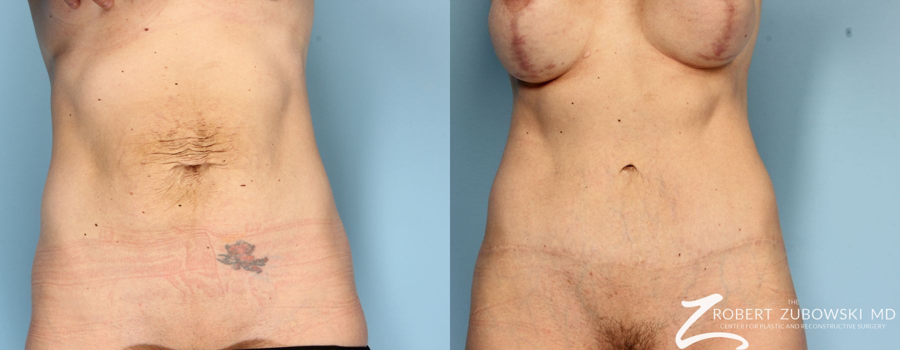Tummy Tuck - Case 3578