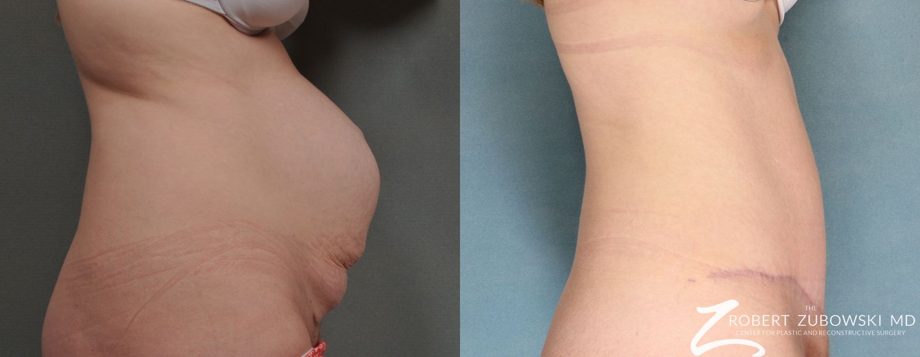 Tummy Tuck - Thumbnail 2