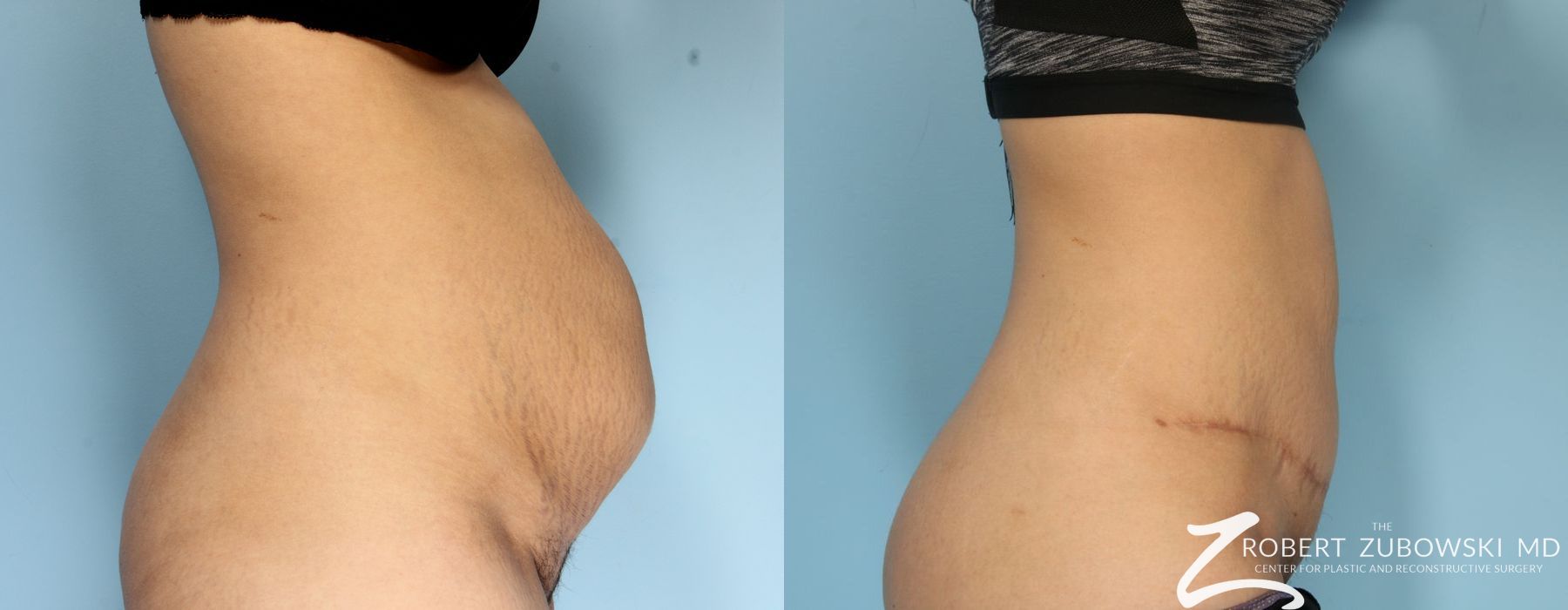 Tummy Tuck - Case 3601