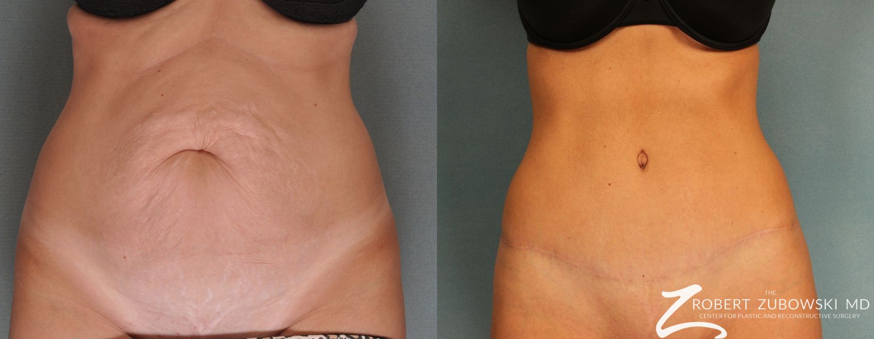 Tummy Tuck - Case 3585