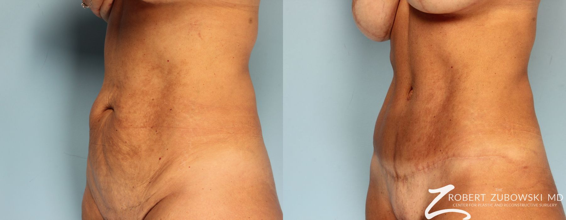 Tummy Tuck - Thumbnail 3