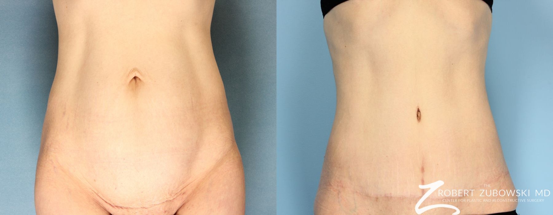 Tummy Tuck - Case 3587