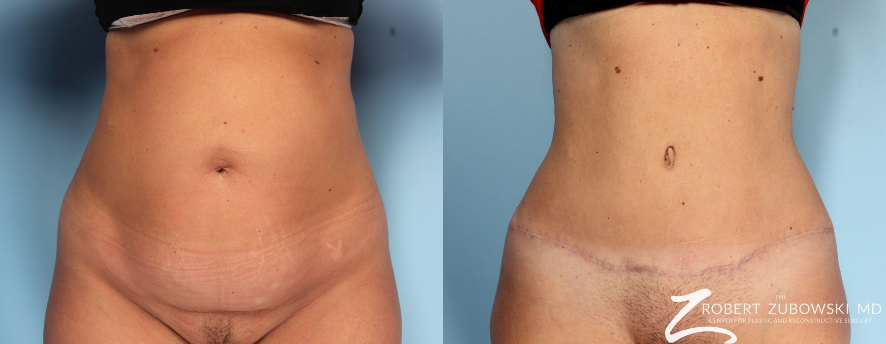 Tummy Tuck - Case 4040
