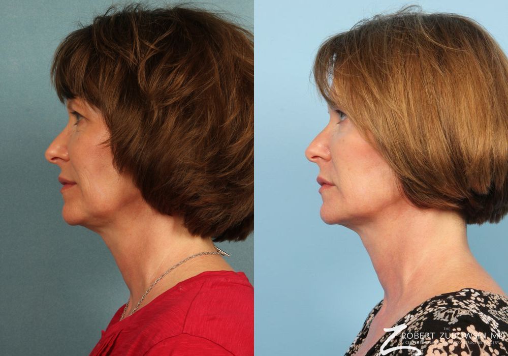 Ultherapy® - Thumbnail 2