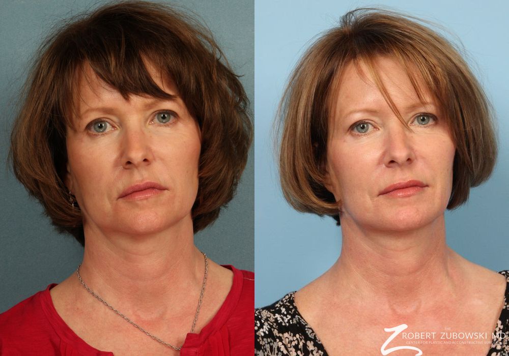 Ultherapy® - Case 3928