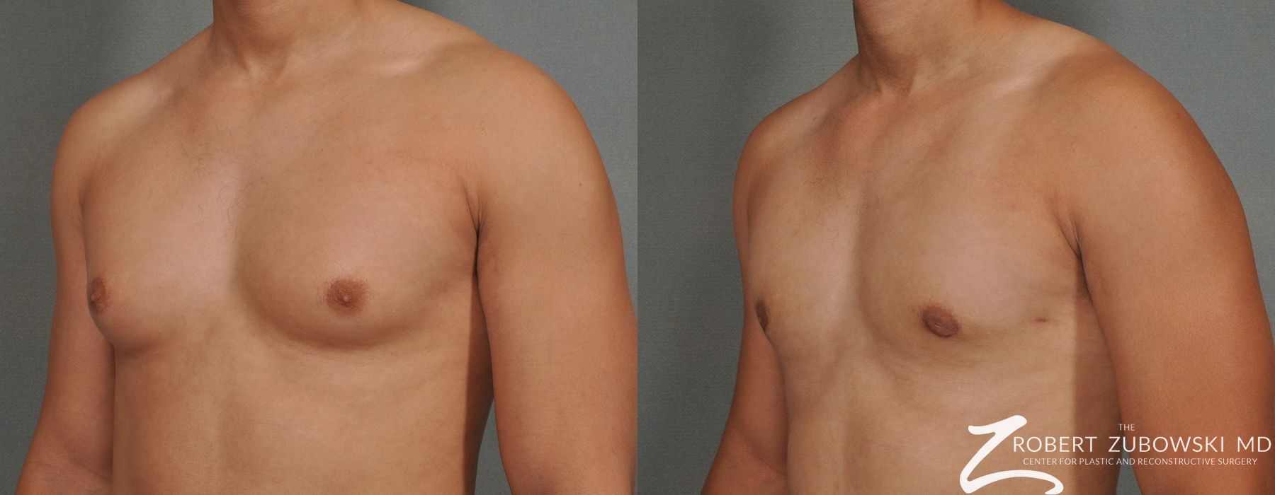 Gynecomastia - Thumbnail 2