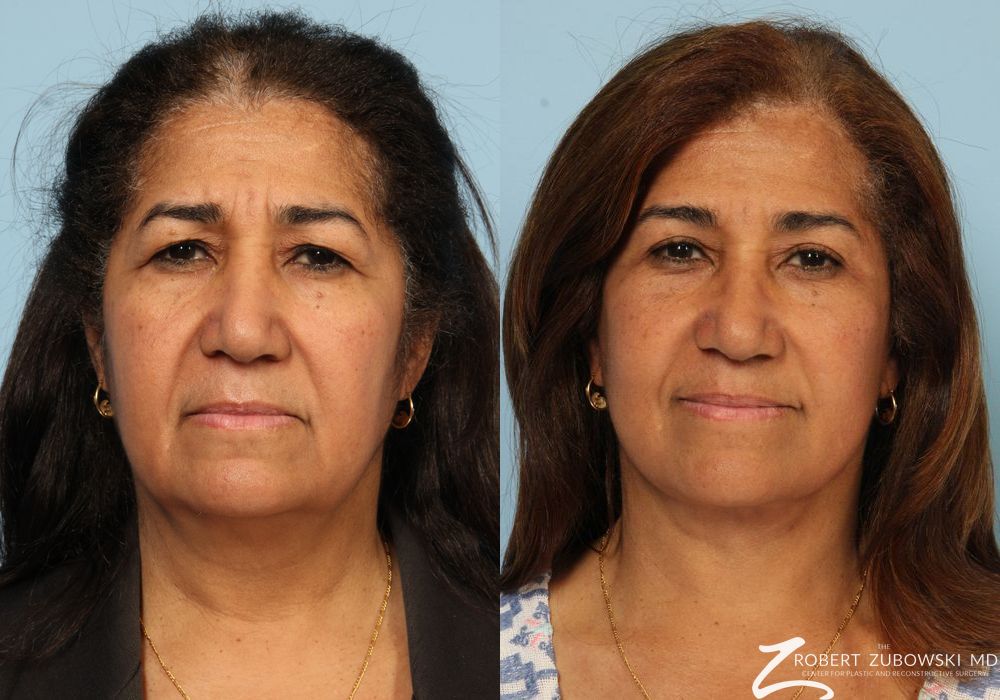 Blepharoplasty - Case 3758